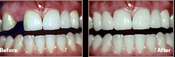 bridge before and after