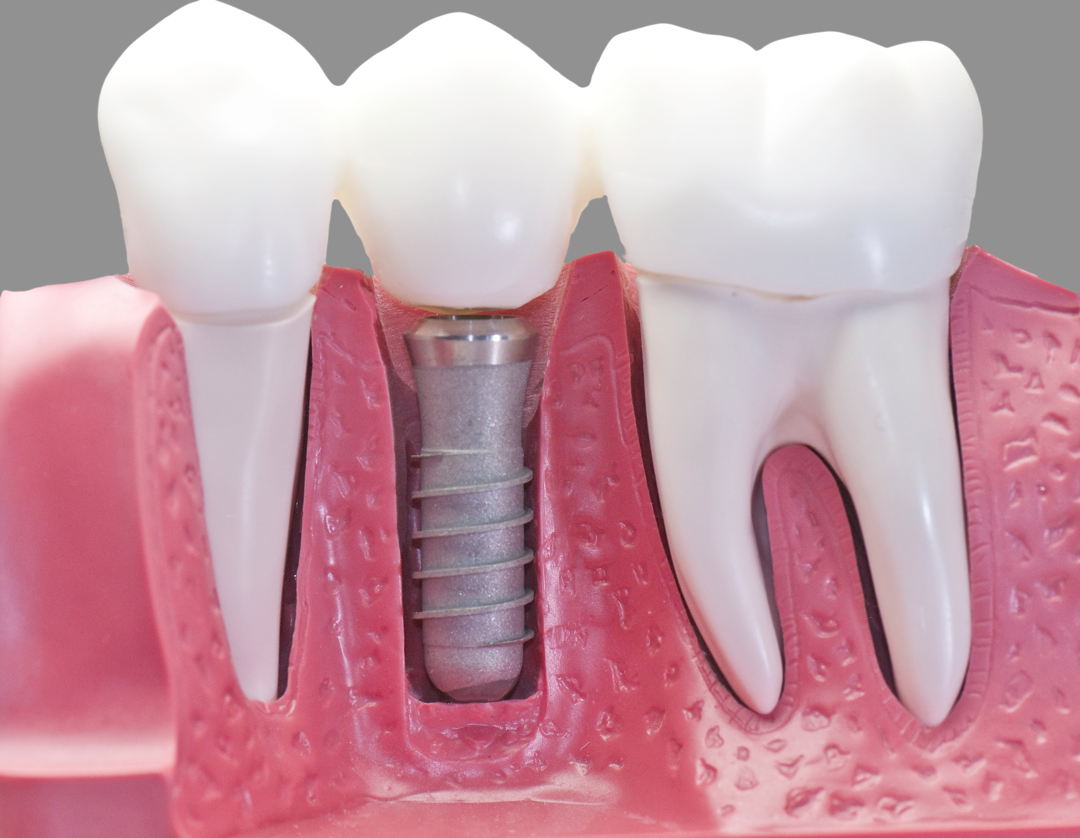 dental implant