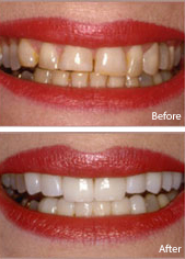 before and after veneers